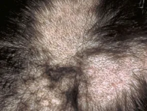 Tricotillomania