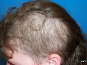 Tricotillomania