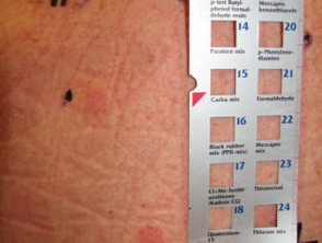 Serie de referencia de alérgenos de prueba de parche