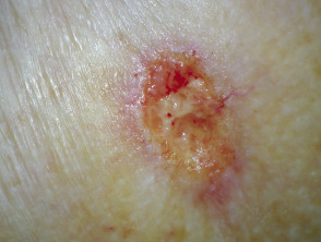 Carcinoma ulcerante de células basales, brazo