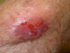 Carcinoma ulcerante de células basales, codo
