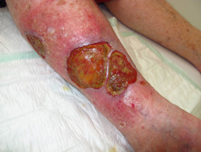 Ulceración venosa