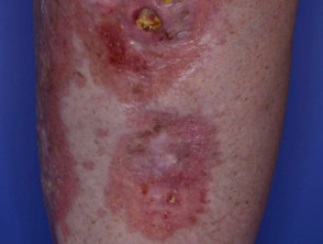 Necrobiosis lipoidica ulcerada