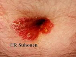 Psoriasis der Nabelschnur