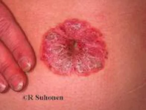 Psoriasis der Nabelschnur