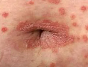 Psoriasis der Nabelschnur