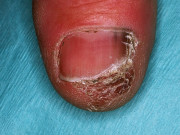 Melanoma de uñas