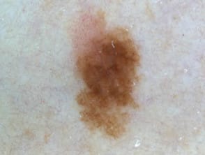 Nevus atípico