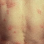 urticaria-303__protectwyjqcm90zwn0il0_focusfillwzi5ncwymjisinkildkwxq-3334776-5074292-jpg-8038120