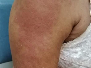 Orticaria che colpisce il braccio 