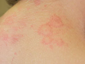 urticaria