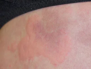 urticaria