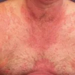 urticaria2__protectwyjqcm90zwn0il0_focusfillwzi5ncwymjisingildfd-3773785-2511382-jpg-8398718