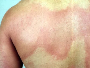 Urticaria