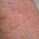 orticaria-weals__protectwyjqcm90zwn0il0_focusfillwzi5ncwymjisingildeyxq-1721891-2734256-jpg-5500916