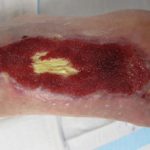 vac-wound1__protectwyjqcm90zwn0il0_focusfillwzi5ncwymjisingildfd-8633272-4816475-jpg-3496053