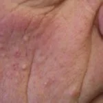 vemurafenib-folliculitis__protectwyjqcm90zwn0il0_focusfillwzi5ncwymjisinkilduzxq-7325942-5130703-jpg-7846306