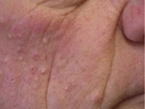 Vemurafenib-folliculitis