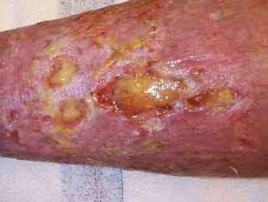 Úlcera venosa de la pierna