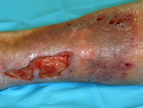 Úlcera venosa de la pierna