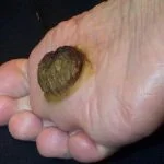 verrucous-ca__protectwyjqcm90zwn0il0_focusfillwzi5ncwymjisingildfd-7823841-5632568-jpg-6440450
