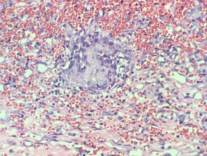 Pathologie van wrattenhemangioom