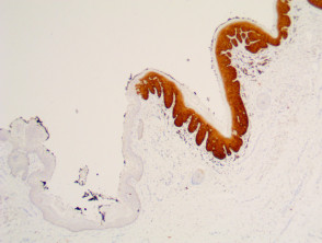 Patología de neooplasia intraepitelial vulvar con tinción p16 x40