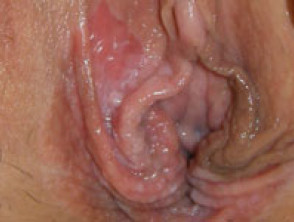 Cáncer de vulva