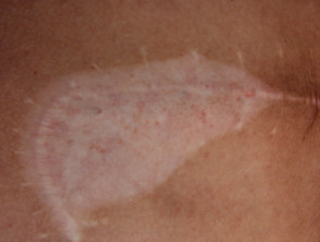Vitiligo koebnerizado