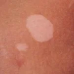 vitiligo-09__protectwyjqcm90zwn0il0_focusfillwzi5ncwymjisingildfd-1864990-7017824-jpg-2278867
