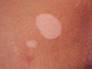 vitiligo-09__protectwyjqcm90zwn0il0_focusfillwzi5ncwymjisingildfd-1864990-7017824-jpg-2278867