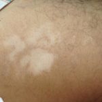 vitiligo-figure-1__protectwyjqcm90zwn0il0_focusfillwzi5ncwymjisinkildzd-4152108-9316925-jpg-7626859