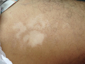 Vitiligo in het gluteale gebied