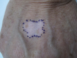 Cirugía de vitiligo