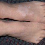 vitiligo1__protectwyjqcm90zwn0il0_focusfillwzi5ncwymjisingildfd-4898383-5115027-jpg-1096483