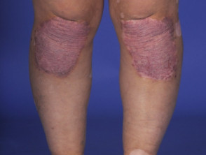 Vitiligo y psoriasis en paciente con síndrome de Vogt-Koyanagi-Harada