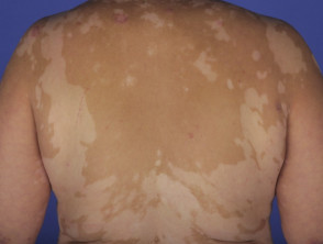 Vitiligo en el síndrome de Vogt-Koyanagi-Harada