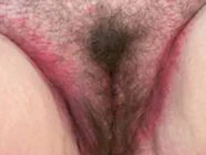 Vulva Psoriasis