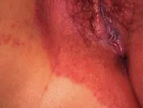 Vulva Psoriasis