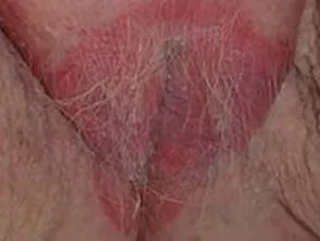 Vulva Psoriasis