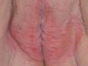 Vulva Psoriasis