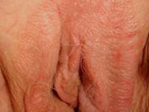 Psoriasis vulvar