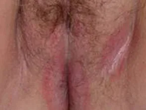 Vulva Psoriasis