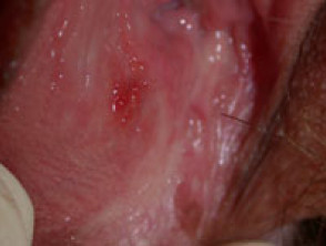 Úlcera vulvar