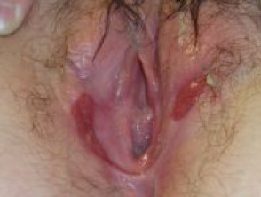 Úlcera vulvar