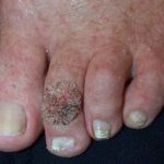 wart2__protectwyjqcm90zwn0il0_focusfillwzi5ncwymjisingildfd-6112455-7356435-jpg-2480244