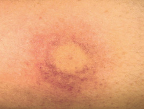 Reacción de picadura de avispa que causa vasculitis loalizada con púrpura