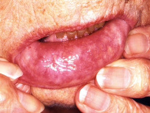 Ulceración labial por granulomatosis con poliangeítis