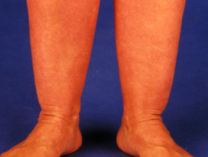 Dermatitis por rascarse la piel seca