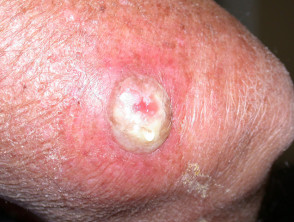 wound-infection1__protectwyjqcm90zwn0il0_focusfillwzi5ncwymjisingildfd-9321172-7522628-jpg-4493497